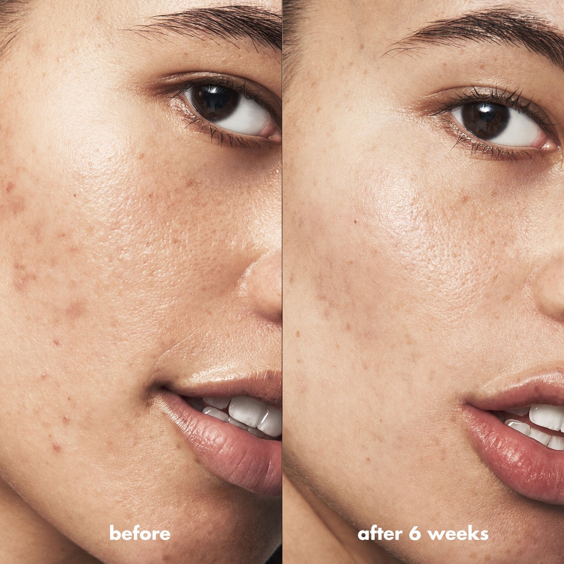 blemish-breakthrough-triple-acid-resurfacing-serum-u2 Acne_PDP_Isabella_Before_After_b8fe0505-ae5c-4baa-9a8e-fd889e4c3414.jpg