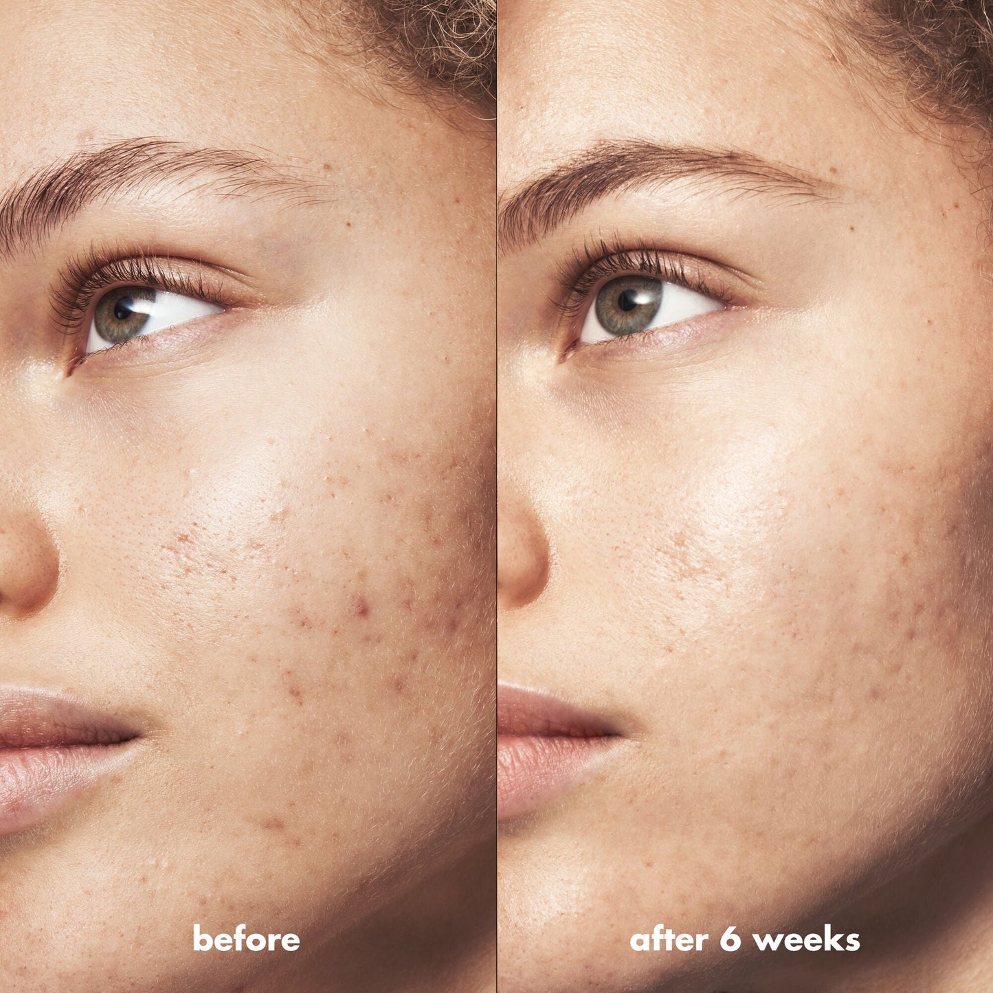 blemish-breakthrough-acne-clarifying-cleanser-p8 Acne_PDP_Marley_Before_After_216490cc-567c-424e-91eb-5374368f15d6.jpg